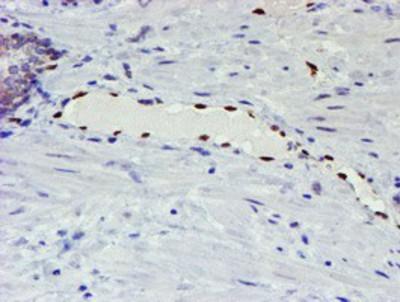 Staining of paraffin-embedded Carcinoma of Human prostate tissue using anti-elk3