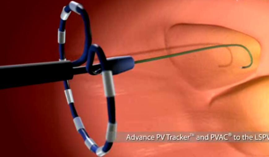AF catheter ablation Early access before proven safety?