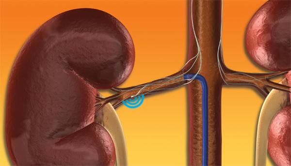 RENAL DENERVATION FOR HTA Early access before proven clinical benefit?