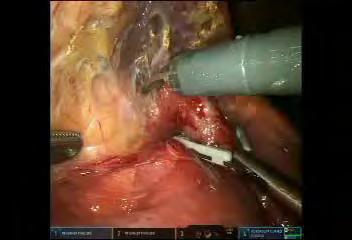 REVISION GASTRIC BYPASS WITH