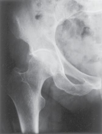 Example Hip Implant With age or