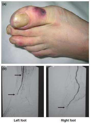 Ischaemiclesion of the left first toe in a patient