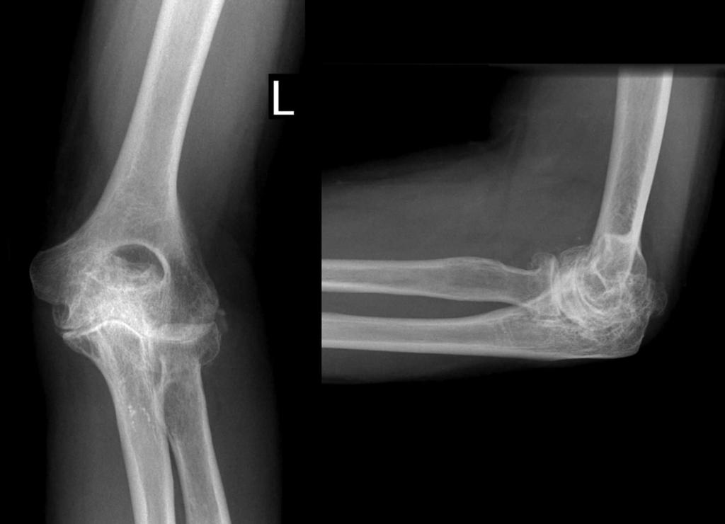 Preoperative anteroposterior and lateral radiographs showing the severe arthropathic changes of the left elbow with advanced joint-space narrowing