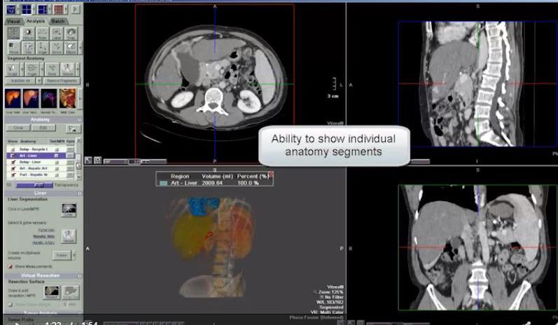 Uses fast 3D reconstruction for rotational digital subtraction acquisition (DSA) imaging so that vascular structure can be depicted in a single imaging procedure, while subtracting bone and tissue.