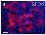 blockbuster sales OpRegen Suspension of retinal pigment epithelial (RPE) cells for dry