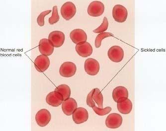 Sickle cell Disease Caused by defective allele for beta-globin (a polypeptide in hemoglobin)