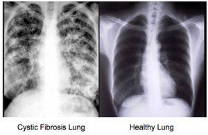 Cystic Fibrosis Most common in Europeans Most cases result from deletion of just three bases in the gene for a protein