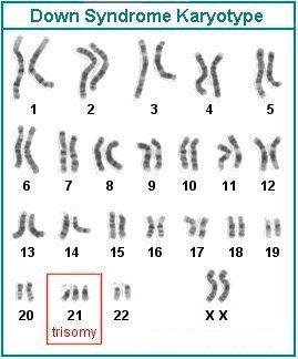 a chromosome Down syndrome is caused by three copies of chromosome 21 Turner s syndrome is when a female only