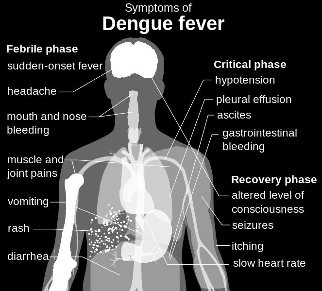 Dengue fever is a viral disease transmitted by mosquitoes. It's sometimes called "break bone fever" because of the severe joint pain it can cause in extreme cases.