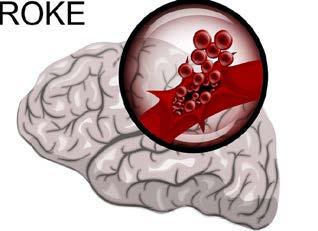 A Stroke Is a Brain Attack and it Can Happen to Anyone, at Any Time, at Any Age Prevalence Causes Treatment Market/CAGR ( 17-22) Ischemic Stroke 90% of stroke cases