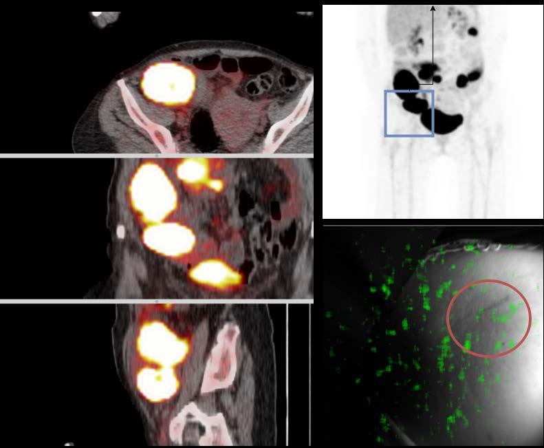 13.4 CLI-04 On the left; transverse, coronal and sagittal planes of the PET CT fusion images. The upper right shows the maximum intensity projection of the PET scan.