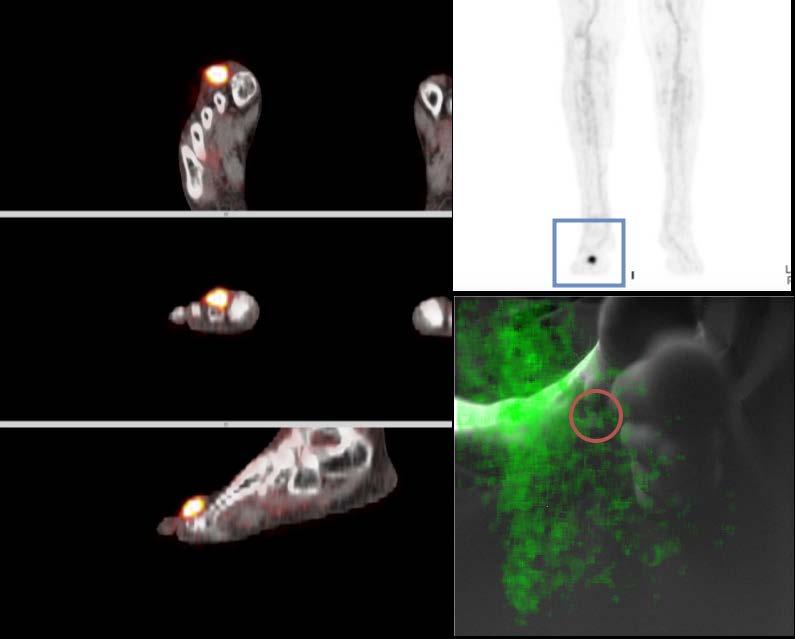 13.5 CLI-05 On the left; transverse, coronal and sagittal planes of the PET CT fusion images.