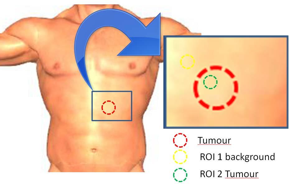 Figure 30 If the dashed red circle represents the tumour the blue square will be the imaging area that is captured with the camera.