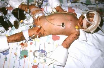 1 year old baby admitted to AE at