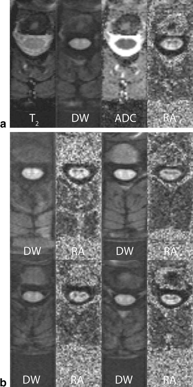 OVS for Spinal Cord Diffusion Imaging 629 images may be attributed to the relatively low SNR, partial-volume effects, and possibly also to imprecise coregistration.
