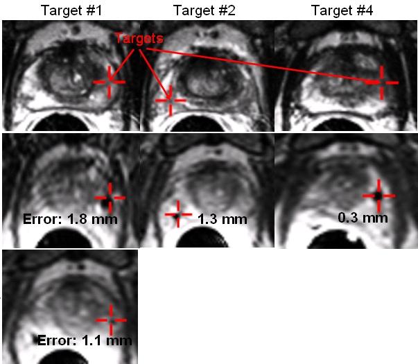 Figure 4 shows the results of the combined procedure. Four targets were selected on axial T2 weighted FSE images (Figure 4, top row).