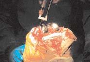 Floryan Berghoff OCTOBER 2004, VOL 80, NO 4 Figure 5 Autologous platelet gel is applied to the total knee arthroplasty implant.