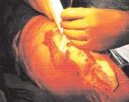 The surgeon applies the autologous platelet gel to cut bone surfaces, synovia, tendons, and the lining of the wound at closure (Figure 6). The scrub person prepares the PPP in a similar fashion.