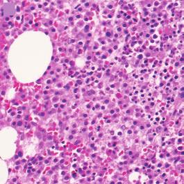 T h e n e w e ng l a nd j o u r na l o f m e dic i n e A B C D E Figure 1. Bone Marrow Biopsy Specimens from Two Patients with Smoldering Multiple Myeloma.
