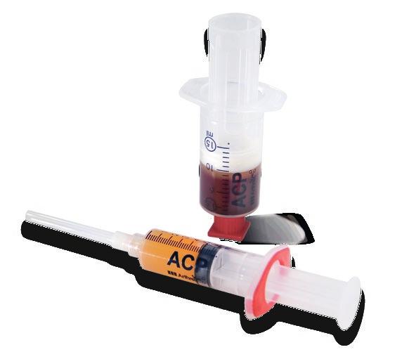 Arthrex ACP There is a growing interest in the use of autologous blood products, such as platelet-rich plasma (PRP), for a number of orthopedic therapies, as growth factors released by platelets