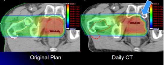 Mayo Clinic Half Gantry Limited to two imaging angles FOV is 30 cm x 30 cm at isocenter may not see center of tumor volume for non-isocentric plans Not CBCT capable Utility of CBCT for Protons Bony