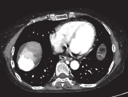(Case 2) A 63-year-old woman Dynamic CT (Fig.