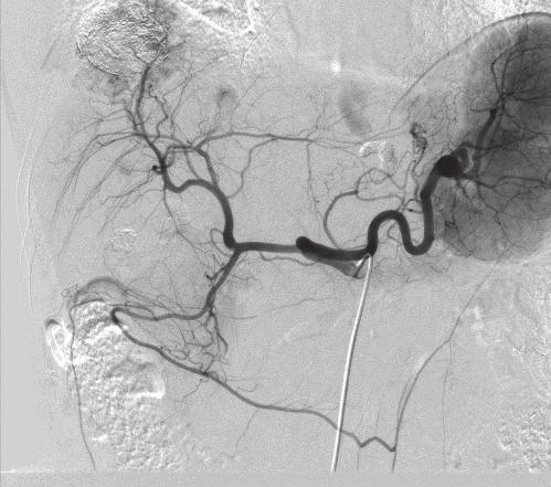 Fig. 11 compared images of the celiac artery obtained by G4 and our hospital's current angiography system.