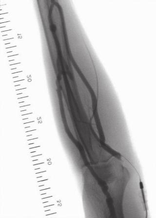 As shown by Case 1 and Case 2, using a wide fieldof-view FPD made it possible to perform imaging from the distal part of the radius to the elbow joint during percutaneous shunt dilatation surgery.