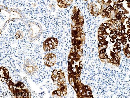 4b (x200) Insufficient CK9 staining of the thyroid papillary carcinoma (high-level expressor) using the same protocol as in Figs. b - 3b.