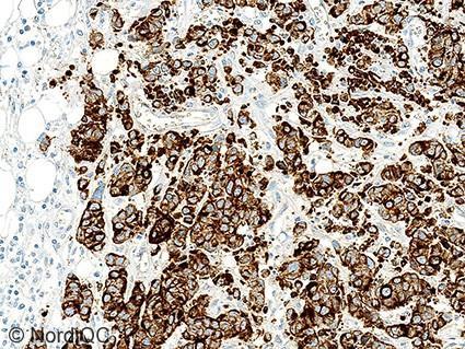 Compare with Fig. 4a same field. Fig. 5a (x00) Optimal CK9 staining of the neuroendocrine carcinoma (low expressor) using same protocol as in Figs.