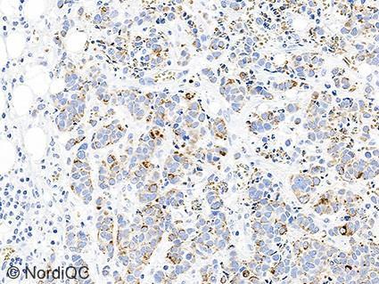 5b (x00) Insufficient CK9 staining of the neuroendocrine carcinoma (low expressor) using the same protocol as in Figs. b - 4b.