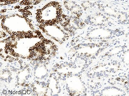 6b (x200) Insufficient CK9 staining of the breast carcinoma using the b70 in a protocol using proteolytic pretreatment.