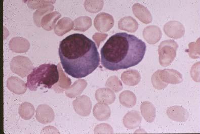 Marrow Plasmacytosis in Myeloma Plasma cells > 10% Usually much higher Often present in sheets