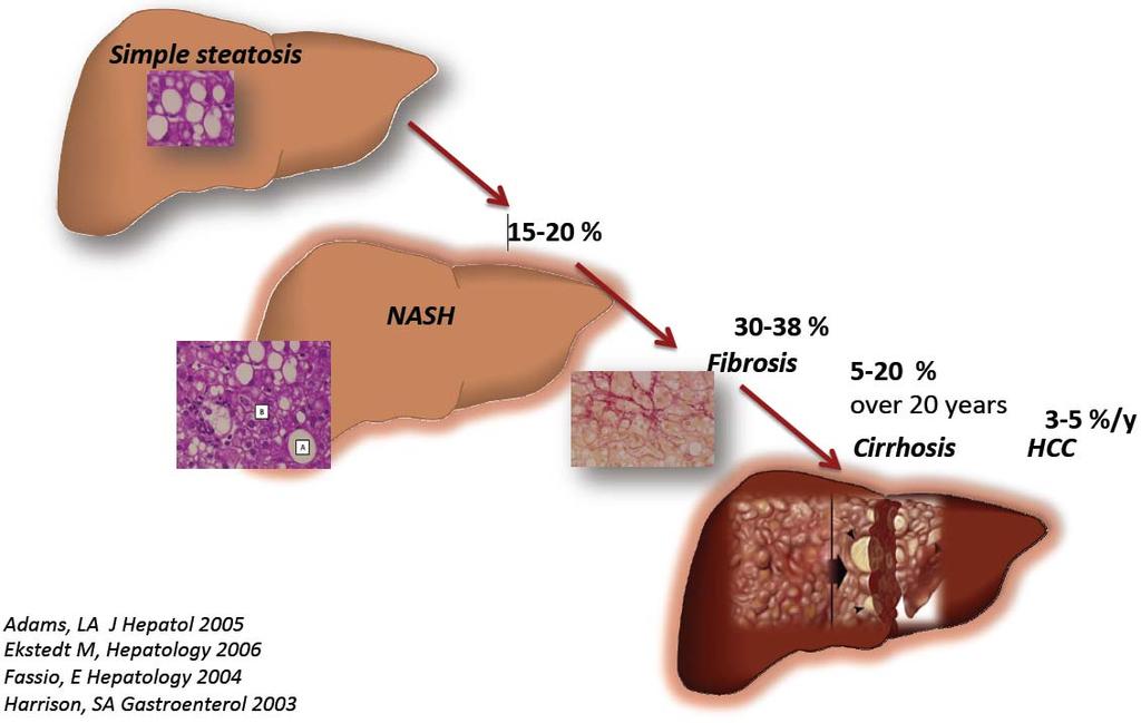 Our therapeutic focus in NASH Two complementary targets in the progression of non alcoholic fatty liver disease 30-40% of US population have steatosis (fatty liver)