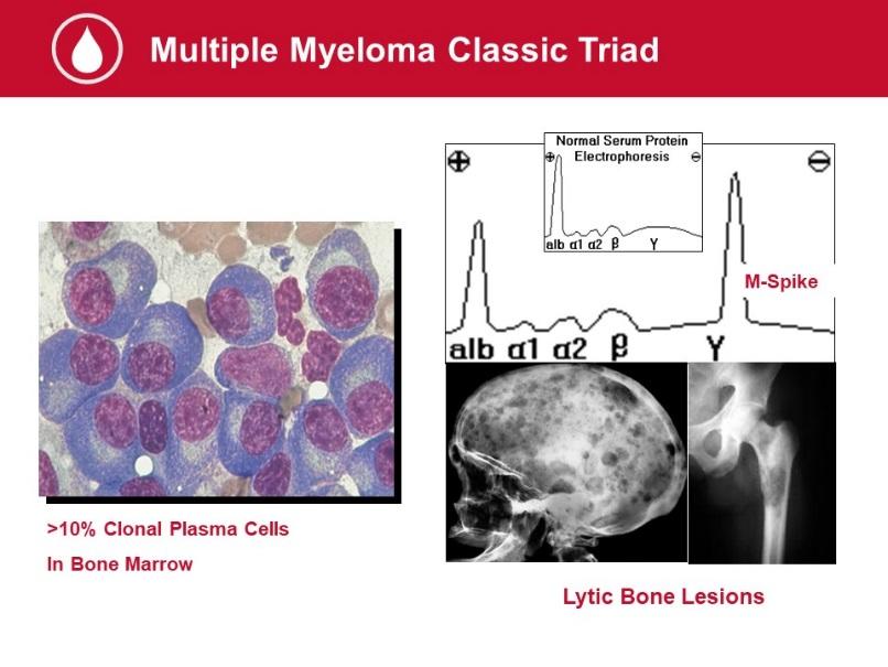 So just as a little bit of a background, what is multiple myeloma?