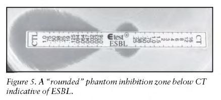 Occasionally, a rounded zone (phantom zone) may be seen below the CTL