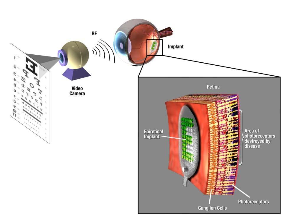 Biomimetic Micro Electronic Systems (BMES) Engineering Research Center First FDA-Approved Retinal prosthesis (2013) First implanted device used to treat adult patients with advanced