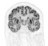 High resolution brain image demonstrating clear differentiation of grey and white matter, as well as