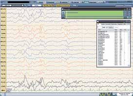 Easy Sentinel Nurse Monitoring Station The Easy Sentinel Nurse Monitoring Station is designed specifically to allow clinical staff to monitor up to 6 patients undergoing Easy III EEG recordings on
