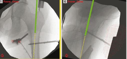 Figure 4a. Finding of the insertion point in navigated femoral nailing Figure 4b. Distal locking.