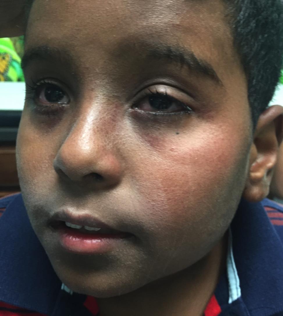 Sam s Story 9 year old boy in Virginia History of seasonal allergic rhinitis.