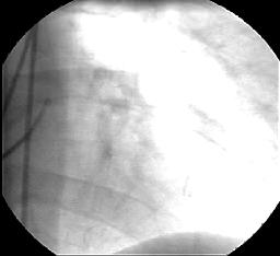 Angiography continuous