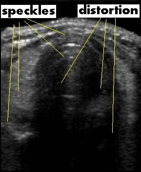 Ultrasound imaging: characteristics No radiation Poor resolution (1mm) nonuniform, distortion, noise Low penetration
