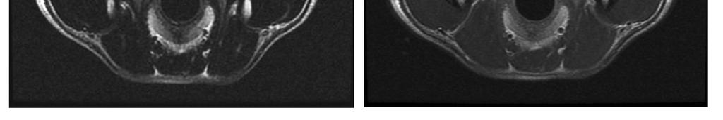 In T2W images, the mass is confluent with edema that appears hyperintense, whereas both of these abnormalities are isointense to the rest of the brain in pre-contrast T1W