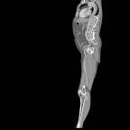 Whole Body CTA CT angiography, typically limited to individual areas of the body with single-slice scanners, can be expanded to include the whole body for angiography screening on Mx8000.