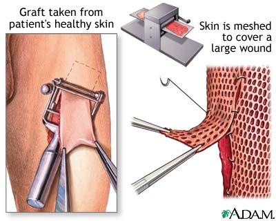 Traditional Skin Grafts Autograft: skin is transplanted from one part of the patients body to another Skin is meshed to cover a greater