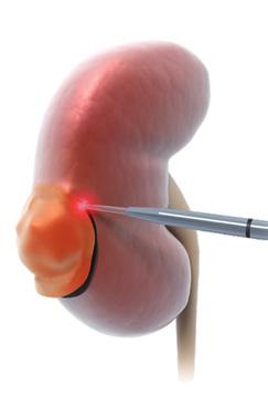 Tumor surgery Our specialty fibers ensure a safe treatment of bladder tumors powered by optimized absorption in water and hemoglobin when utilizing the Ceralas HPD laser, LEONARDO DUAL 45 or LEONARDO