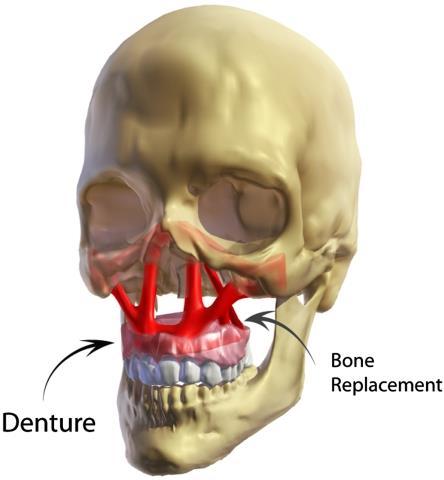 Craniofacial Defects Craniomaxillofacial reconstruction often requires complex, multistage surgical procedures.
