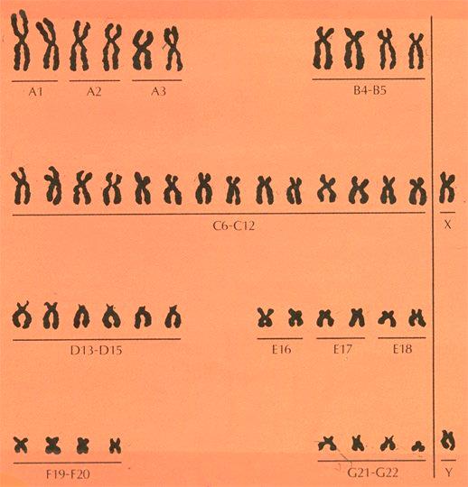 Exercise III Karyotype Analysis A number of human genetic disorders, including
