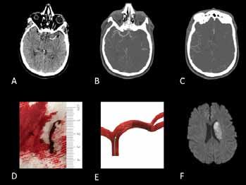 Gauquelin et al. 780 CASE Clinical REPORT Images Peer Reviewed OPEN ACCESS Failed thrombolysis in a 56-year-old aphasic and hemiplegic patient, what s next?